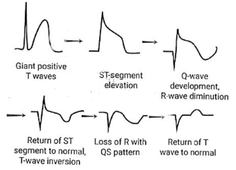 Acute Myocardial Infarction-Clinical features - Medical Science ...