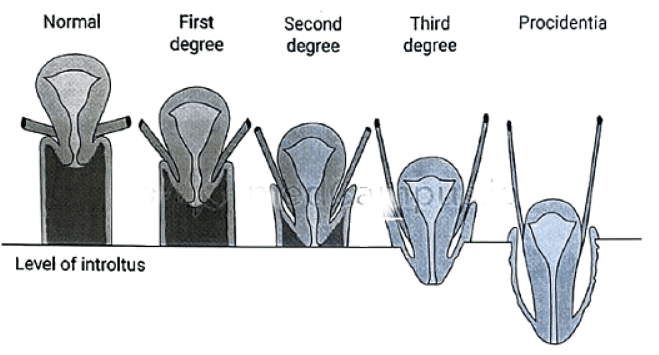 Prolapse of uterus - Medical Science Optional Notes for UPSC PDF Download