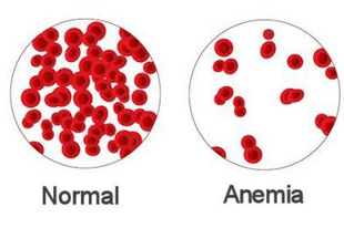 Anaemia: Reduced Red Blood Cells