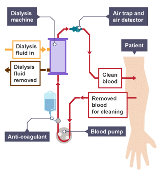 Treating Kidney Failure - Biology for Grade 10 PDF Download