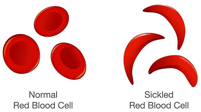 What is Sickle Cell Disease? | CDC