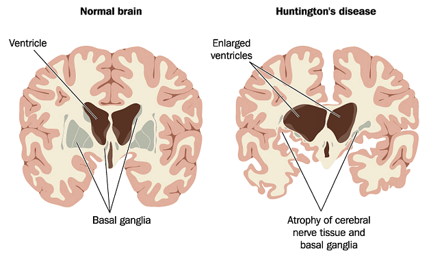 Huntington&amp;#39;s Disease – a Rare Genetic Disorder of the Brain | Medanta