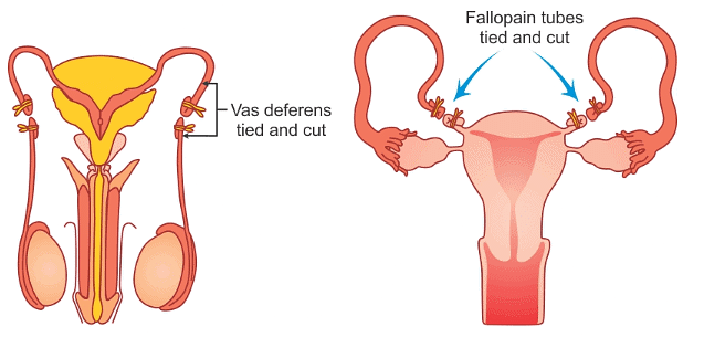 (a) Vasectomy and (b) Tubectomy