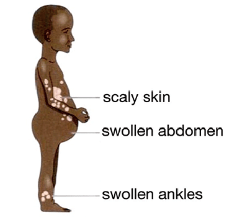 Symptoms of Kwashiorkor