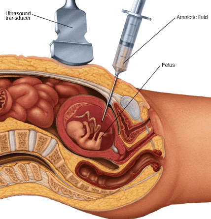  Amniocentesis 