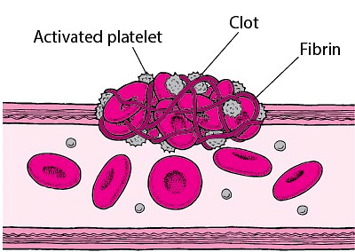 Activated Platelets forming a Clot