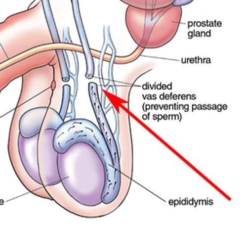 Vasectomy