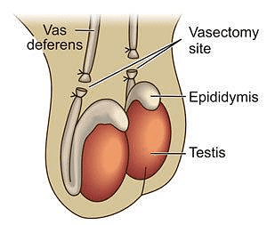 Vasectomy in males