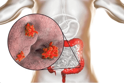 E. histolytica feeding in human large intestine