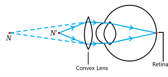 Correction of Hypermetropic Eye