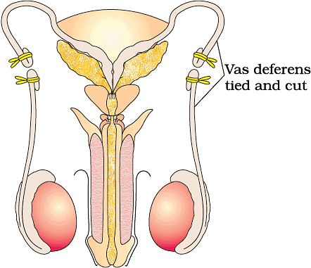 NEET Previous Year Questions (2014-22): Reproductive Health - Notes | Study Biology Class 12 - NEET
