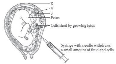 amniocentesis diagram