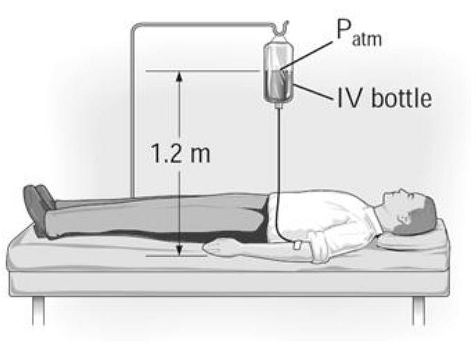 Intravenous infusions are usually driven by gravity by hanging