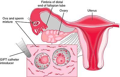 Gamete Intrafallopian Tube Transfer (GIFT) | Treatment for Male Infertility  | Trivandrum