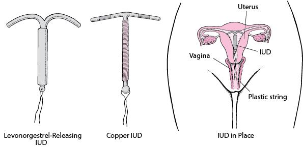 Intrauterine Devices (IUDs) - Women's Health Issues - MSD Manual Consumer  Version