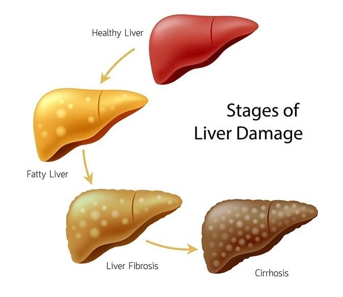 What Causes Cirrhosis?